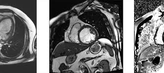 Une anxiété inexpliquée peut accompagner l essoufflement. L Insuffisance Cardiaque Ffc