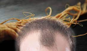 We did not find results for: Hair Loss Treatment A Plant That Prevents Natural Cell Death To Increase Hair Growth Sound Health And Lasting Wealth