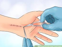 How To Exercise After Carpal Tunnel Surgery Carpal Tunnel Surgery Carpal Tunnel Carpal Tunnel Surgery Recovery