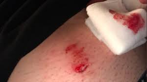 The person should still be able to walk and run but the motions of the arms (while running) will be painful. Man Recounts How Belt Buckle Deflected A Bullet Meant For Him Sunday Morning Wtvc