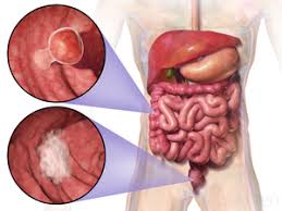Colon cancer symptoms can be confusing. Colorectal Cancer Wikipedia