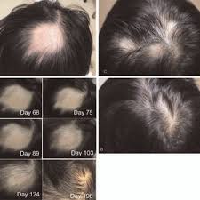 For the past two decades, acupuncture for hair loss has been gradually gaining prominence worldwide. Acupuncture For Alopecia Areata A Filiform Needles With A Diameter Download Scientific Diagram