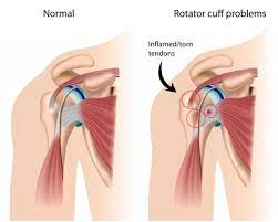 Maybe you would like to learn more about one of these? Shoulder Tendonitis