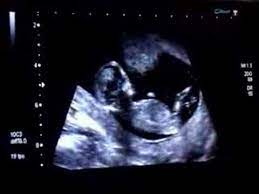 Ultraschall 13 Woche Baby Hupft Youtube