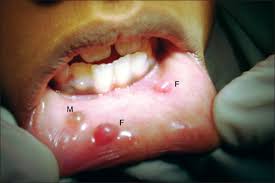 Mucous retention cyst can occur in many regions of the body like the maxillary the appearance of these mucous retention cysts on very vital parts of the body makes the person suffering from it worry a lot. A Rare Presentation Of Mucocele And Irritation Fibroma Of The Lower Lip Rangeeth B N Moses J Reddy Vk Contemp Clin Dent