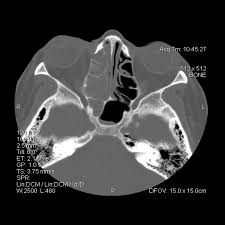 Nathalie quiroz1, janeth del pilar villanueva2, edgar andrés lozano3. Sinusitis Trastornos Otorrinolaringologicos Manual Merck Version Para Profesionales