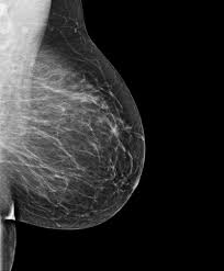 Doing additional breast imaging provides more detailed information about your case and helps you and your physician make decisions about further evaluation. if your screening mammogram is abnormal, a radiologist will likely recommend further imaging such as Mammogram Diagnostic Imaging Mount Miriam Cancer Hospital