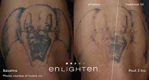 Tattoo removal has been performed with various tools since the start of tattooing. Laser Tattoo Removal Dr Eugene Zappi Dr Laura Buccheri Zappi