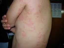 Gatal pada kaki dapat disebabkan oleh kulit kering, eksem, infeksi, atau meskipun jarang terjadi, gejala penyakit tertentu. Cara Menghilangkan Gatal Gatal Di Badan Dengan Ramuan Bumbu Dapur Obat Herbal De Nature Paling Ampuh