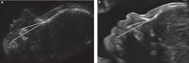 Fetal Facial Profile Markers Of Down Syndrome In The Second And Third Trimesters Of Pregnancy Vos 2015 Ultrasound In Obstetrics Amp Gynecology Wiley Online Library