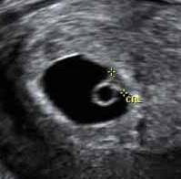 Because you have a choice. What Will I See At A 5 Week Early Pregnancy Scan Why Should I Wait Un Earlylife