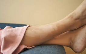 Image result for Pigment stains on the shin