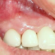 Once the abscess spreads to othe. Swelling Ice White Dental