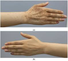 Image result for Diffuse Hyperpigmentation