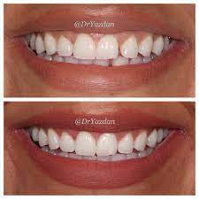 Straight Teeth Why You Should Have Them Center For Restorative Cosmetic Dentistry