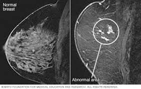 It is referred to as inflammatory due to its frequent presentation with symptoms resembling a skin inflammation, such as erysipelas. Tukn8mabzjjemm