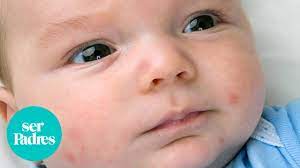 Granos En La Cara Del Bebe A Que Pueden Deberse Youtube