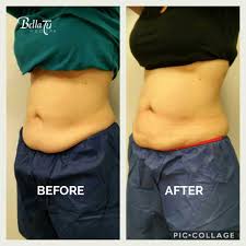 You can expect belly treatments to last between 35 and 60 minutes. Coolsculpting Bella Tu Med Spa With Director Kim Mcgarry