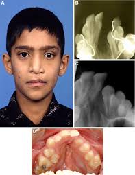 The Clinical Application of Recombinant Human Bone Morphogenetic Protein 7  for Reconstruction of Alveolar Cleft: 10 Years' Follow-Up