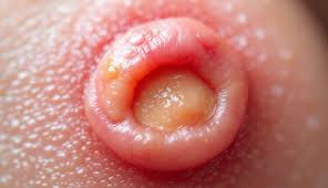 Image result for chancroid