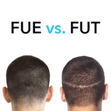 Maybe you would like to learn more about one of these? Fut Vs Fue Comparison What You Need To Know