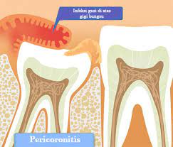 Pertumbuhannya sering menimbulkan masalah, karena gigi bungsu sering tumbuh miring. Efek Samping Gigi Bungsu Yang Miring Audy Dental