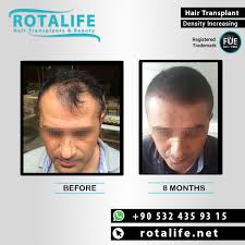 Hair Transplant Turkey