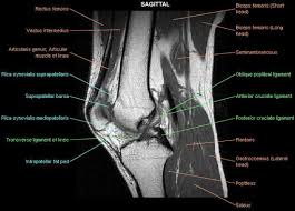 Articular surface of patella and femur, condyle, epicondyle and muscles (popliteus, . Knee Imaging Knee Sports Orthobullets