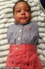 Thai nhi bị chẩn đoán mắc hội chứng hiếm gặp trên thế giới nhưng bà mẹ vẫn  sinh con dù bé không có chân tay