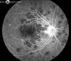 Typically, apmppe causes central vision loss in one or both eyes in young adults with the development of gray, white, or yellow, flat plaques that are predominantly located in the posterior pole at the level of. Acute Posterior Multifocal Placoid Pigment Epitheliopathy Apmppe