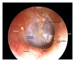 Image result for Eustachian Tube Dysfunction