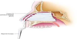 Image result for Nasal Packing