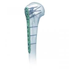 Proximal Humeral Locking Plate Ⅱ,Medical Device ...