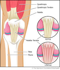 The best treatment for achilles tendonitis (tendinitis). Jumper S Knee Patellar Tendonitis