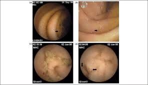 「videos/load/recent ~gastrointestinal」的圖片搜尋結果