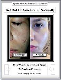 Well, you are just six remedies away from achieving clean skin. Get Rid Of Acne Scars Naturally How To Clear Acne Scared Skin Kindle Edition By Vlado Micheal Demitro Shirley Professional Technical Kindle Ebooks Amazon Com