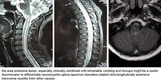 Transverse myelitis interrupts the messages that the spinal cord nerves send throughout the body. Differentiation Of Neuromyelitis Optica Spectrum Disorders From Ultra Longitudinally Extensive Transverse Myelitis In A Cohort Of Chinese Patients Sciencedirect