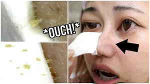 Watch Me Cry While Peeling Off Blackheads Youtube