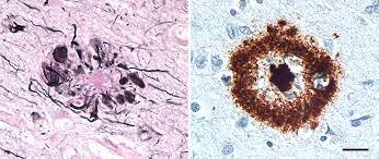 Join flo in exploring alzheimer's camel test alternatives that better target the symptoms of this degenerative disease. Ab Plaques