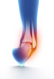 Cherchez des exemples de traductions entorse dans des phrases, écoutez à la prononciation et apprenez la fr blessure d'un ligament ou d'un tendon causé par un étirement soudain. Entorse De Cheville Pied Et Chevillepied Et Cheville