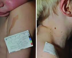 They are caused by a col. Ein Mehrstufiger Algorithmus Zur Diagnose Seltener Genodermatosen Tantcheva Poor 2016 Jddg Journal Der Deutschen Dermatologischen Gesellschaft Wiley Online Library