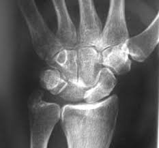 Image result for Lunate Dislocation