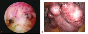 Image result for Recurrent Miscarriage
