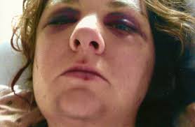 I dumped my boyfriend… then he strangled me unconscious, beat me to a  bloody pulp and left me for dead