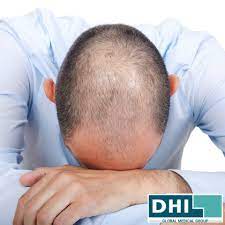 An average of 100 to 150 hair strands lost per day is considered normal. Going Bald Too Young Top Tips From The Hair Loss Experts Dhi Global