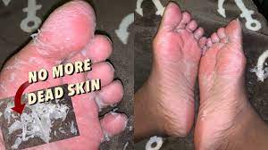 Being highly acidic in nature, lemon also helps get rid of dead skin cells on your feet. Peeling All The Dead Skin Off My Feet Intense Foot Peel For Baby Smooth Feet Youtube