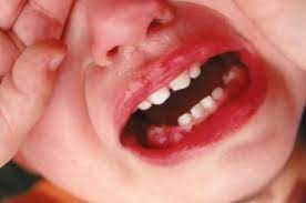 How To Treat The Fever For An 8 Month Old Baby Swollen Gum Baby Teething Fever Teething Gums