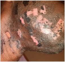 Image result for Postinflammatory Hypopigmentation