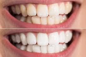 Find everything to fuel your health at biovea Everyday Uses Of Hydrogen Peroxide For Skin Hair Teeth And Beauty Femina In