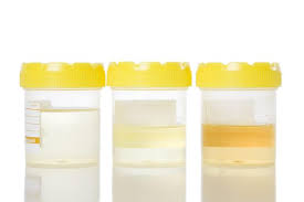 Hal itu bisa membuat kencing anda berwarna kuning pekat atau hijau. Apakah Maksudnya Jika Air Kencing Anda Berwarna Oren